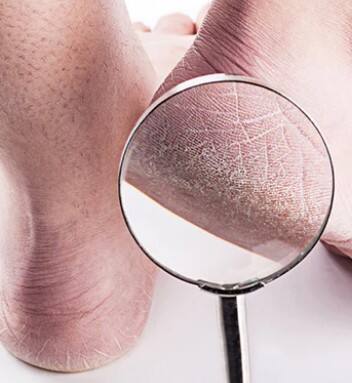 ਕਿਹੜੇ ਵਿਟਾਮਿਨ ਦੀ ਕਮੀਂ ਨਾਲ ਫੱਟਦੀਆਂ ਅੱਡੀਆਂ?