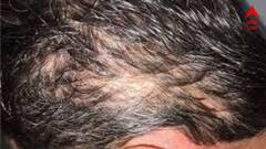Haifall Problem: অল্প বয়সে চুল পড়ছে ক্রমাগত? কী করা উচিৎ আপনার?