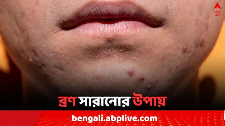 Pimples Remides: মুখে ব্রণ হলে অস্বস্তি হয় সবারই। তার মধ্যে যদি সুন্দর মুখে মাঝে মধ্যেই ব্রণ হয় তাহলে অস্বস্তির পরিমাণ বেড়ে যায় বহুগুণ। জেনে নিন ঘরোয়া উপায়ে ব্রণ দূর করার উপায়।