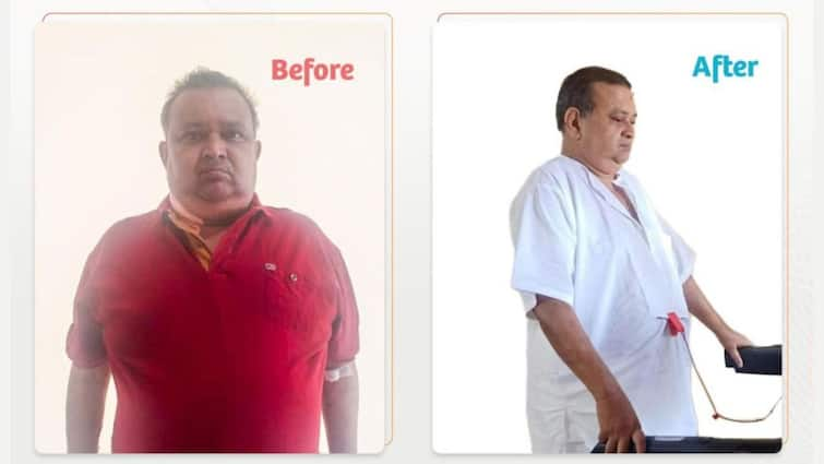 Jayeshkumar Jani's Life Transformed Through Bariatric Surgery: A Journey to a Healthier Future