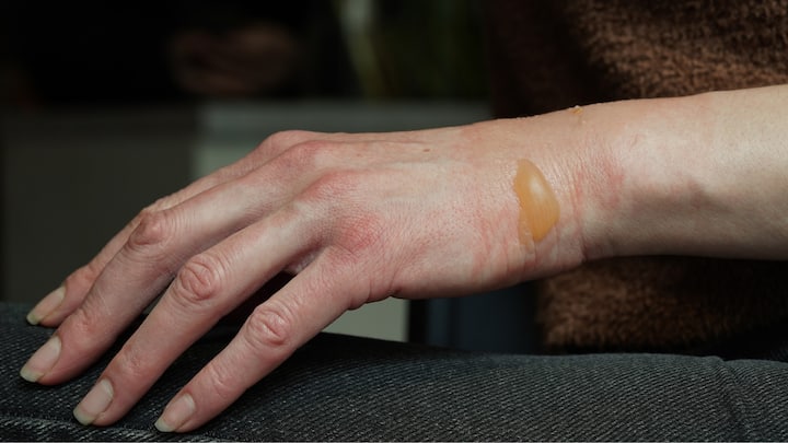 1. One of the most common health issues during Diwali is burn injuries. This should be prevented by wearing pure cotton clothes as synthetic fabrics catch fire easily. Closed shoes should be worn to avoid any burn injuries of feet. Wearing of any dupattas or any trailing piece of cloth to be avoided while lighting fire crackers. (Image source: Canva)