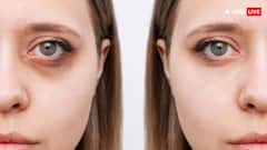 Dark Circles Home Remedy: आंखों के नीचे से गायब हो जाएंगीं झुर्रियां, बस रोज कर लें ये एक काम