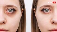 Dark Circles Home Remedy: હવે તમારા આંખોની નીચેની કરચલીઓ ગાયબ થઈ જશે, માત્ર રોજ કરો આ એક કામ