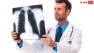 Tuberculosis Disease: कोरोना की जगह ले सकता है TB, हर साल इतने लाख लोग हो रहे हैं बीमार