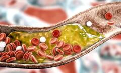 આ વસ્તુઓ ખાવાથી વધી જાય છે કોલેસ્ટ્રોલ, ન કરો આ ભૂલ