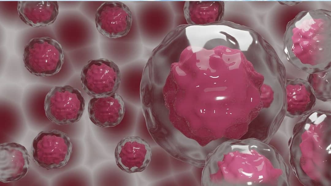 Myeloma Explained — Insights Into The Disease And Its Treatment Myeloma Explained — Insights Into The Disease And Its Treatment