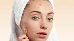 Pimple Scar Prevention: ব্রণ ফাটিয়ে ফেললেও দাগ হবে না মুখে, মেনে চলুন এই নিয়মগুলি...