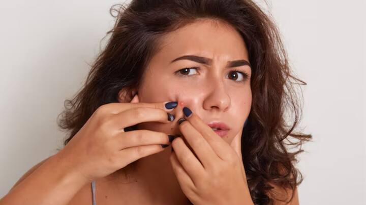 Pimple Scar: ব্রণ কখনওই ফাটানো উচিত নয়। কিন্তু ফাটিয়ে ফেললে কী করণীয়, জানুন। ছবি: ফ্রিপিক।