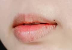 શિયાળામાં તમારા હોઠ ફાટવા લાગે છે, તો આ ઘરેલું ઉપાય આપશે ફાયદો