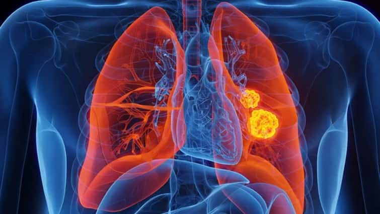 From now on, you will no longer die of lung cancer! Revolutionary Breath Test Makes Detection Easier