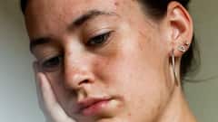 6 Amazing Benefits Of Tretinoin For Your Skin