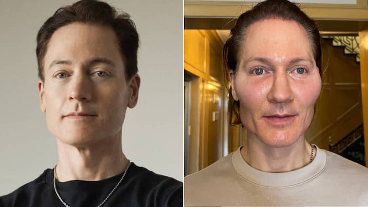 Tech Millionaire Bryan Johnson's Face Blows Up After Anti-Ageing Procedure