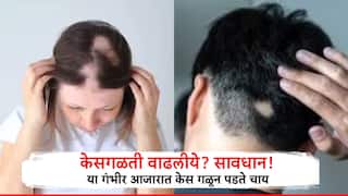 Health:  केस गळतीकडे चुकूनही करू नका दुर्लक्ष, या गंभीर आजारत केस गळून पडते चाय,  तज्ञांनी सांगितलेली लक्षणं अन् उपाय वाचाच..