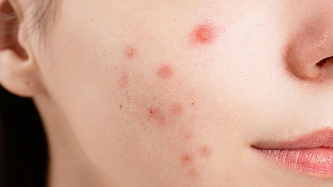 Acne Problem: ব্রন কেন হয়? সবচেয়ে সহজে কীভাবে দূর করবেন এই সমস্যা? skin care tips acne problem why acne created on your skin what are the remedies to solve this problem Acne Problem: ব্রন কেন হয়? সবচেয়ে সহজে কীভাবে দূর করবেন এই সমস্যা?