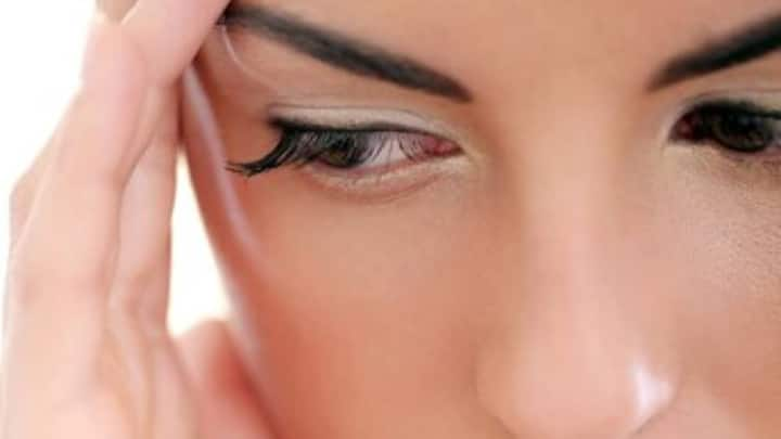 For your information, let us tell you that your habit of sleeping with eyeliner and mascara can also cause dandruff on your eyelashes.