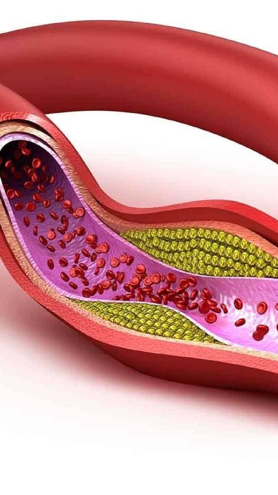 त्वचेवरची 'ही' लक्षणे उच्च कोलेस्टेरॉलची असू शकतात!