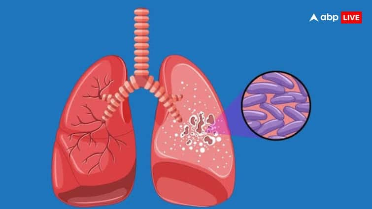 State has highest number of TB patients, drug shortage poses challenge