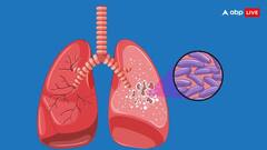 इस राज्य में है टीबी के सबसे ज्यादा मरीज, दवाइयों की कमी बनी चुनौती