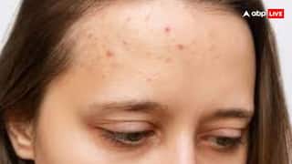 चेहरे के पिंपल्स को न करें इग्नोर, हो सकता है स्किन कैंसर, जानें क्या करें