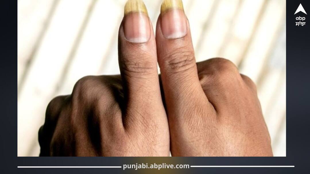 7 Warning Signs in Nails That Indicate Serious Health Issues, Ignoring Them Can Be Costly ਨਹੁੰਆਂ 'ਚ ਨਜ਼ਰ ਆਉਣ ਵਾਲੇ ਇਹ 7 ਸੰਕੇਤ ਕਰਦੇ ਗੰਭੀਰ ਬਿਮਾਰੀਆਂ ਵੱਲ ਇਸ਼ਾਰਾ, ਨਜ਼ਰਅੰਦਾਜ਼ ਕਰਨਾ ਪੈ ਸਕਦਾ ਮਹਿੰਗਾ