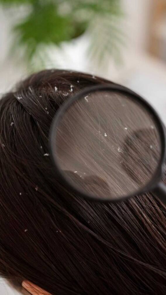 इस विटामिन की कमी से होता है डैंड्रफ