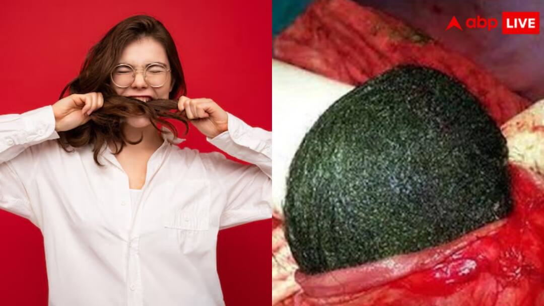 Woman ate her own hair doctors operated on her and removed a 15 cm long hair from her stomach पिज्जा-मोमोज की तरह अपने ही बाल खा जाती है यह लड़की, अब पेट से निकला 'गोला' देख कांप उठे यूजर्स