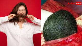 पिज्जा-मोमोज की तरह अपने ही बाल खा जाती है यह लड़की, अब पेट से निकला 'गोला' देख कांप उठे यूजर्स