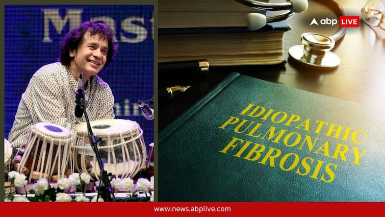 What Is Idiopathic Pulmonary Fibrosis? Zakir Hussain Suffered From This Serious Disease That Affects Lungs