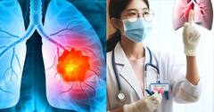 Health Tips: જો શરીરમાં આ લક્ષણો દેખાય તો હોઈ શકે છે ફેફસાનું કેન્સર