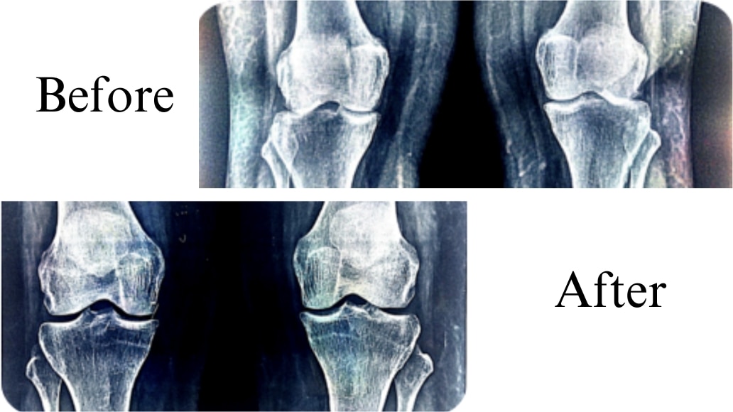 ResearchAyu’s Ayurvedic Treatment For Knee Pain