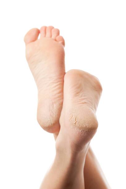 పాదాలు పగులుతున్నాయా? ఈ టిప్స్ ఫాలో అవ్వండి