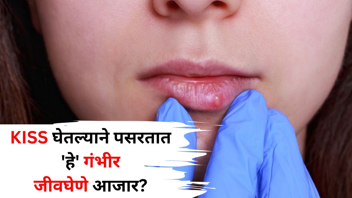 Kissing Disease: खरंच KISS घेतल्याने पसरतात 'हे' गंभीर जीवघेणे आजार? 'ही' लक्षणं तुम्हाला नाही ना? नेमकं सत्य काय? जाणून घ्या