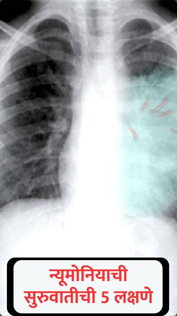 मुंबईत प्रदूषणामुळे वाढतोय न्यूमोनियाचा धोका