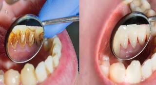 ਦੰਦਾਂ 'ਤੇ ਜੰਮੀ ਪੀਲਕ ਨੂੰ ਹਟਾਉਣ ਲਈ ਹਲਦੀ 'ਚ ਮਿਲਾ ਕੇ ਲਗਾਓ ਆਹ ਚੀਜ਼, ਚਿੱਟੇ ਹੋਣ ਲੱਗ ਜਾਣਗੇ ਪੀਲੇ ਦੰਦ