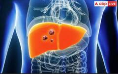 ਪਿਸ਼ਾਬ ਦੇ ਰੰਗ ਤੋਂ ਪਤਾ ਲੱਗ ਸਕਦਾ ਲੀਵਰ ਕੈਂਸਰ, ਕਦੇ ਨਾ ਕਰਿਓ ਨਜ਼ਰਅੰਦਾਜ