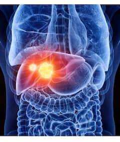 Liver Cancer: ਸਾਵਧਾਨ! ਲਿਵਰ ਕੈਂਸਰ ਵੱਲ ਇਸ਼ਾਰਾ ਕਰਦੇ ਇਹ ਲੱਛਣ, ਜਾਣੋ ਹੌਲੀ-ਹੌਲੀ ਕਿਵੇਂ ਬਣਦੇ ਮੌਤ ਦਾ ਕਾਰਨ ?