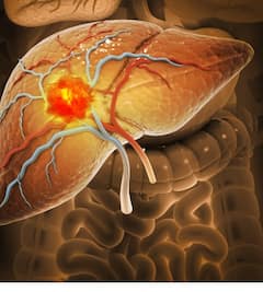 Liver Cancer: ਸਾਵਧਾਨ! ਲਿਵਰ ਕੈਂਸਰ ਵੱਲ ਇਸ਼ਾਰਾ ਕਰਦੇ ਇਹ ਲੱਛਣ, ਜਾਣੋ ਹੌਲੀ-ਹੌਲੀ ਕਿਵੇਂ ਬਣਦੇ ਮੌਤ ਦਾ ਕਾਰਨ ?