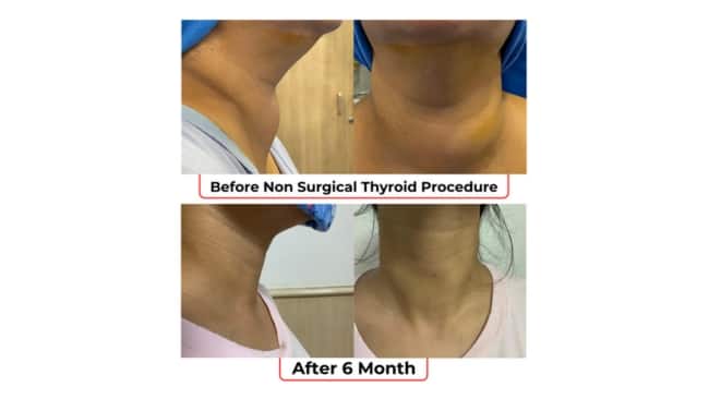 Thyroid Nodule Treatment Without Surgery in Delhi: Success Stories of Radiofrequency Ablation (RFA) & Microwave Ablation (MWA)