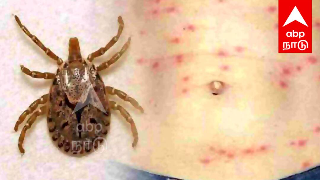 Scrub Typhus : உஷார் மக்களே ! உடம்பில் கருப்பு புள்ளிகள் வருகிறதா ? உடனே டாக்டரை பாருங்க ...!