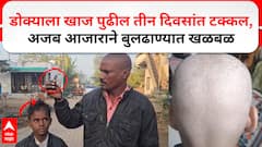 Buldhana Villager Hair Loss : डोक्याला खाज पुढील तीन दिवसांत टक्कल; बुलढाण्यातील शेगावातील घटनाBuldhana Villager Hair Loss : डोक्याला खाज पुढील तीन दिवसांत टक्कल; बुलढाण्यातील शेगावातील घटना