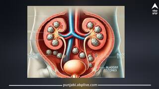 Urinary Bladder Stone ਤੋਂ ਵੱਧ ਸਕਦਾ ਕੈਂਸਰ ਦਾ ਖਤਰਾ! ਜਾਣੋ ਕੀ ਕਹਿੰਦੇ ਮਾਹਿਰ