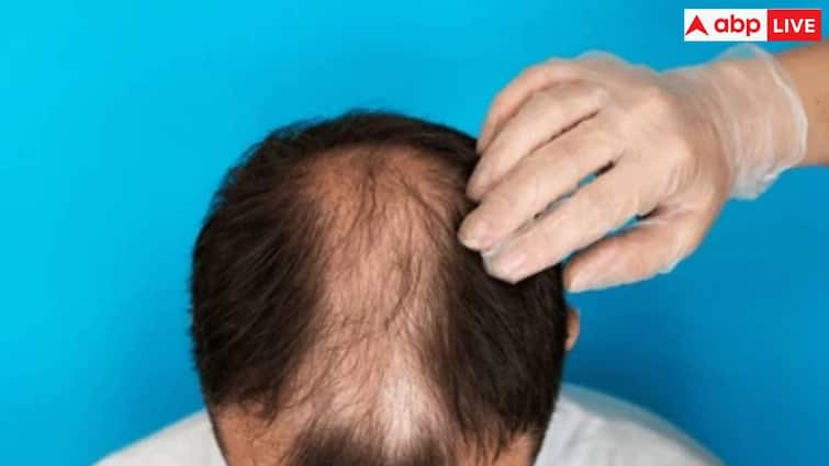 ‘Takla Virus’ Spreads Rapidly in Maharashtra, People Go Bald Within Three Days After Itching