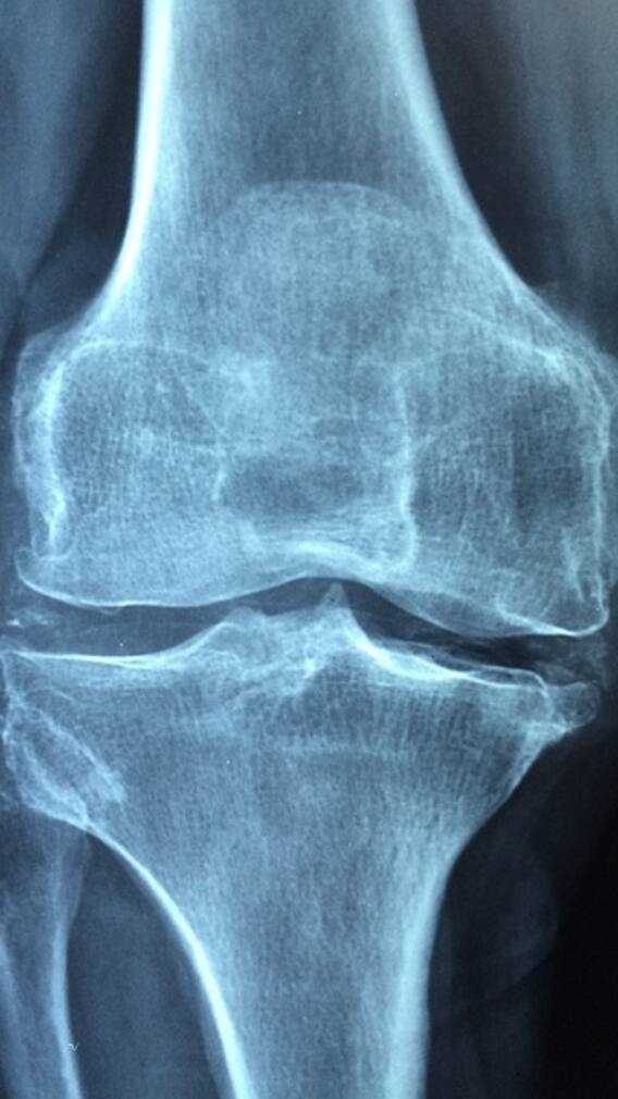 ਗੋਡਿਆਂ ਦੀ ਗ੍ਰੀਸ ਘੱਟ ਹੋ ਗਈ ਤਾਂ ਖਾਓ ਆਹ ਚੀਜ਼ਾਂ