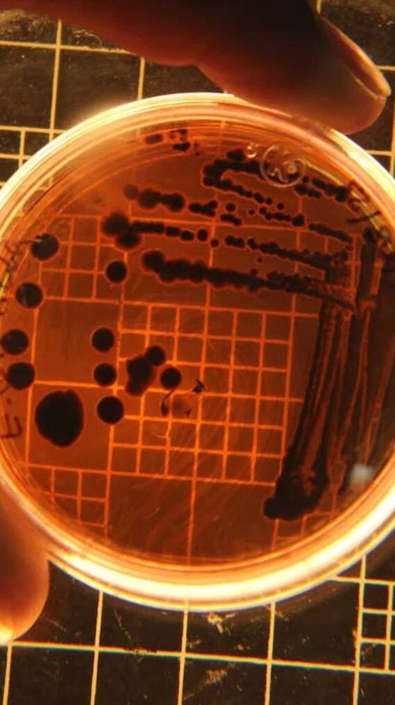 डायबिटीज के मरीजों के लिए HMPV कितना खतरनाक?