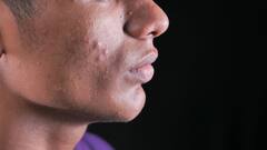 Acne Reduce: মুখ ভর্তির ব্রণর কারণ স্ট্রেস নয় তো! কীভাবে বুঝবেন?