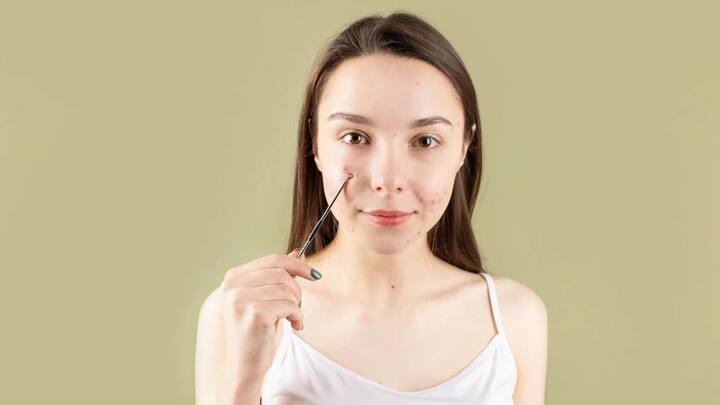 মানসিক চাপ বা উদ্বেগের কারণে ব্রণ হলে তা বিশেষ করে T- Zone- এ ((কপাল, নাক এবং থুতনি)) দেখা যায়। ব্রণ হওয়ার পাশাপাশি ত্বকের মসৃণ ভাব নষ্ট হয়ে যায়। ত্বক প্রাণহীন হয়ে যায়। প্রাকৃতিক উজ্জ্বলতা হারিয়ে যায়। 