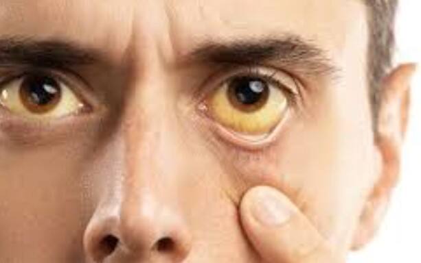 હાઈ કોલેસ્ટ્રોલના કારણે આંખોની આસપાસ જોવા મળે છે આ લક્ષણો, જાણો તેના વિશે These symptoms are seen around the eyes due to high cholesterol હાઈ કોલેસ્ટ્રોલના કારણે આંખોની આસપાસ જોવા મળે છે આ લક્ષણો, જાણો તેના વિશે