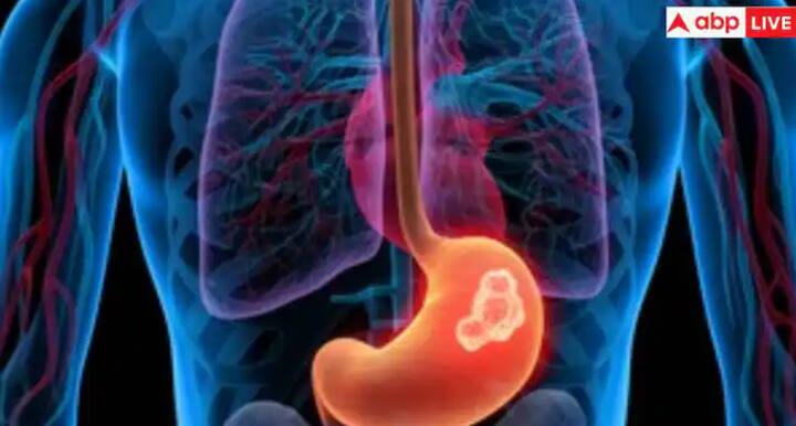 ਜਦੋਂ ਪੇਟ ਚ ਮੌਜੂਦ ਸੈੱਲ ਅਸਧਾਰਨ ਤੌਰ 'ਤੇ ਵਧਣ ਲੱਗਦੇ ਹਨ, ਤਾਂ ਪੇਟ ਚ ਇੱਕ ਟਿਊਮਰ ਬਣਨਾ ਸ਼ੁਰੂ ਹੋ ਜਾਂਦਾ ਹੈ। ਟਿਊਮਰ ਕੈਂਸਰ ਅਤੇ ਨਾਨ-ਕੈਂਸਰ ਵਾਲਾ ਦੋਵੇਂ ਤਰ੍ਹਾਂ ਦਾ ਹੋ ਸਕਦਾ ਹੈ। ਆਓ ਜਾਣਦੇ ਹਾਂ ਪੇਟ ਵਿੱਚ ਟਿਊਮਰ ਹੋਣ ਦੇ ਲੱਛਣ ਕੀ ਹਨ।