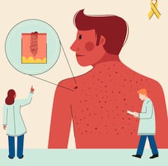 ਸਕਿਨ ਕੈਂਸਰ ਦੇ ਪਹਿਲੇ ਪੜਾਅ 'ਚ ਦਿਖਾਈ ਦਿੰਦੇ ਅਜਿਹੇ ਲੱਛਣ, ਮਰਦ ਰਹਿਣ ਸਾਵਧਾਨ