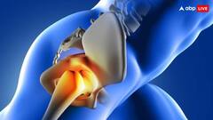 क्या होती है इंसिग्निया स्टेम इम्प्लांट, जिसकी मदद से पहली बार हुई हिप रिप्लेसमेंट सर्जरी